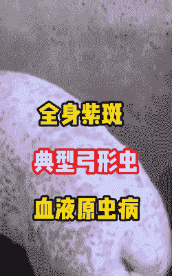 弓形体血虫是什么