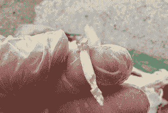 肉鸡咳嗽引起栓塞